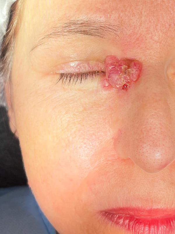 Базальноклітинний рак шкіри медіального кута правого ока Київ